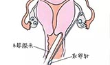 闭经不排卵可以做泰国试管婴儿吗
