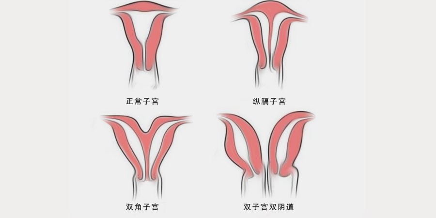 鞍型子宫可以做试管婴儿吗，要注意什么?