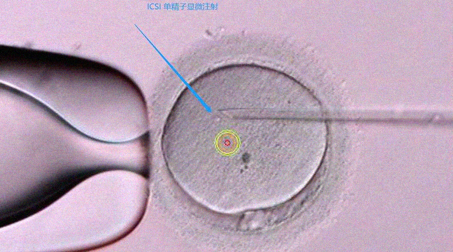 试管婴儿可以做几次