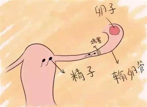 输卵管堵塞是做试管婴儿还是疏通术好?